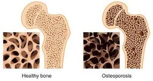 osteoporoza kostiju
